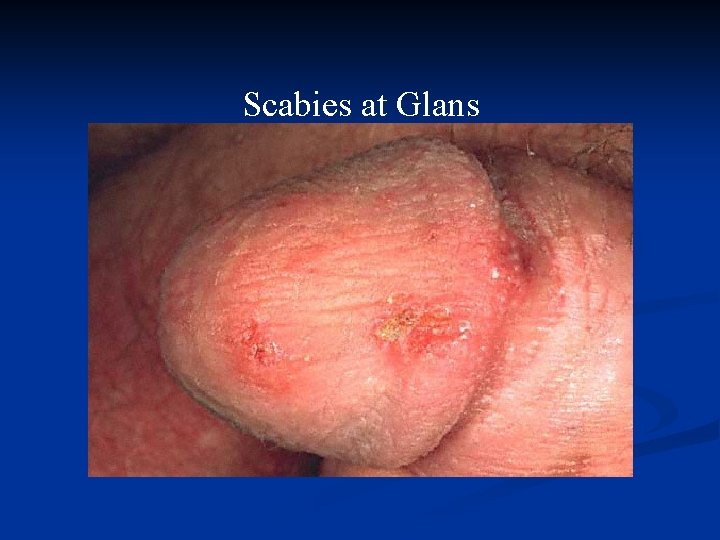 Scabies at Glans 