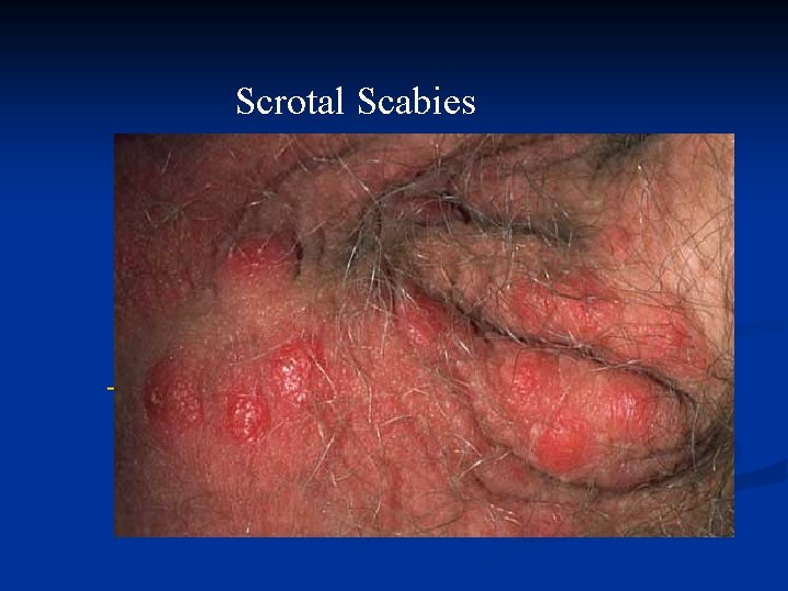 Scrotal Scabies 