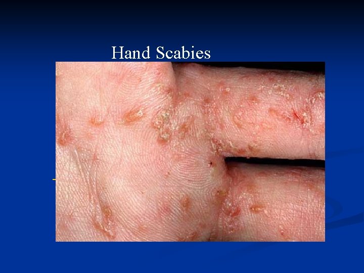 Hand Scabies 