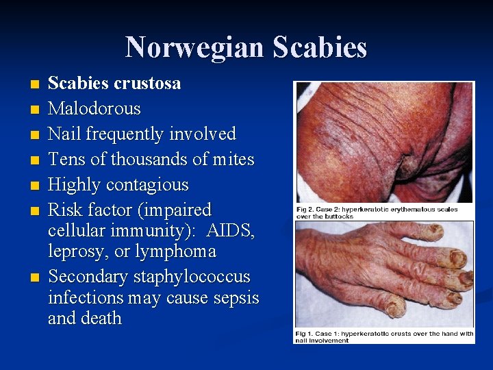 Norwegian Scabies n n n n Scabies crustosa Malodorous Nail frequently involved Tens of