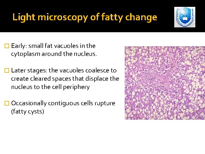 Light microscopy of fatty change � Early: small fat vacuoles in the cytoplasm around