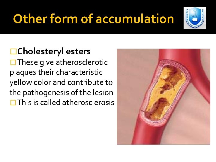 Other form of accumulation �Cholesteryl esters � These give atherosclerotic plaques their characteristic yellow