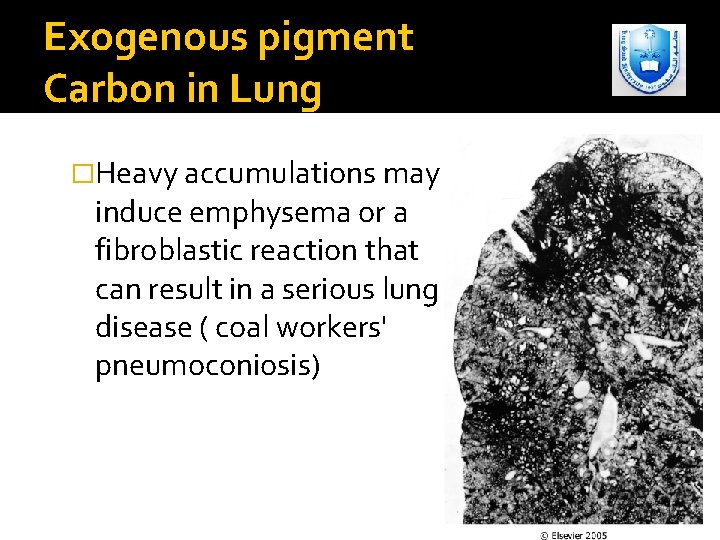 Exogenous pigment Carbon in Lung �Heavy accumulations may induce emphysema or a fibroblastic reaction