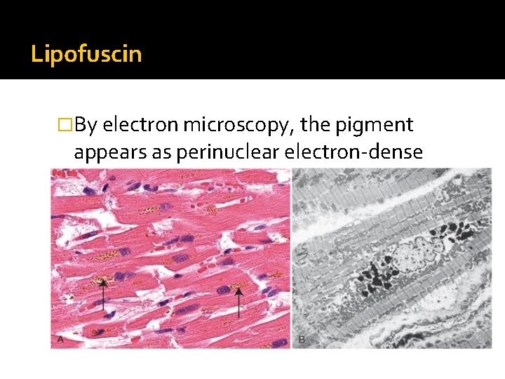 Lipofuscin �By electron microscopy, the pigment appears as perinuclear electron-dense granules 