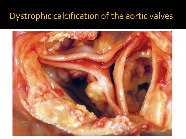 Dystrophic calcification of the aortic valves 