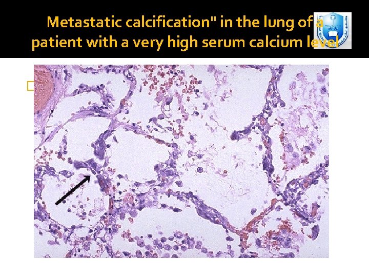 Metastatic calcification" in the lung of a patient with a very high serum calcium