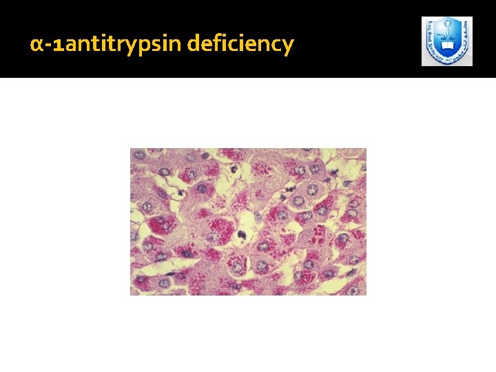 α-1 antitrypsin deficiency 