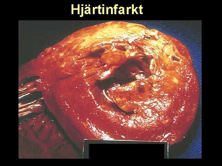 Hjärtinfarkt 