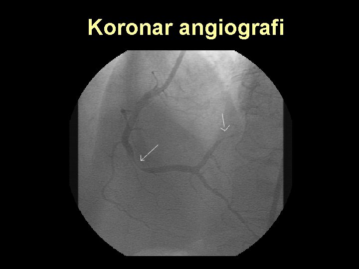 Koronar angiografi 