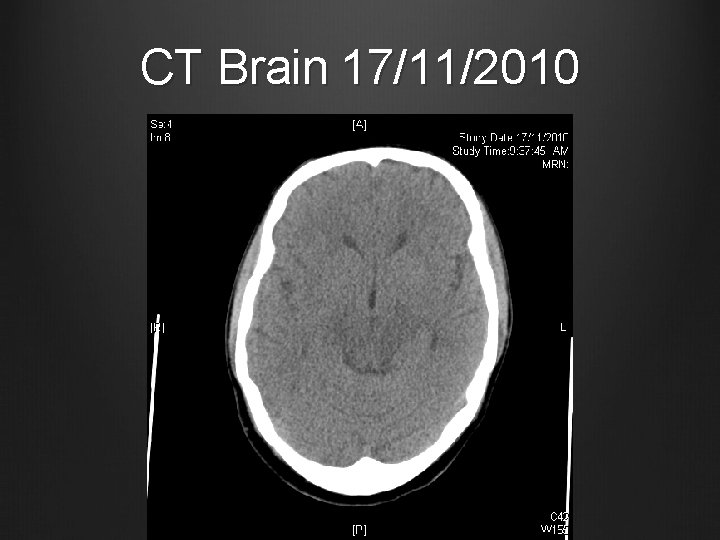 CT Brain 17/11/2010 