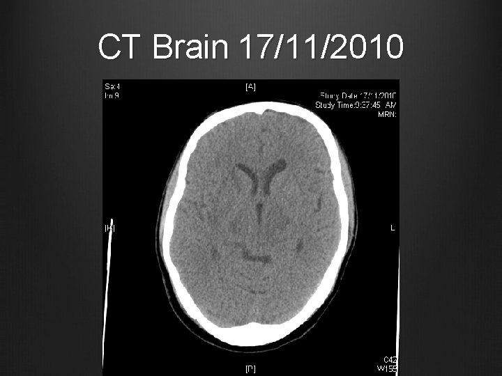 CT Brain 17/11/2010 