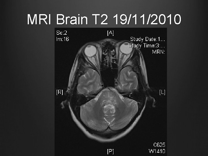 MRI Brain T 2 19/11/2010 