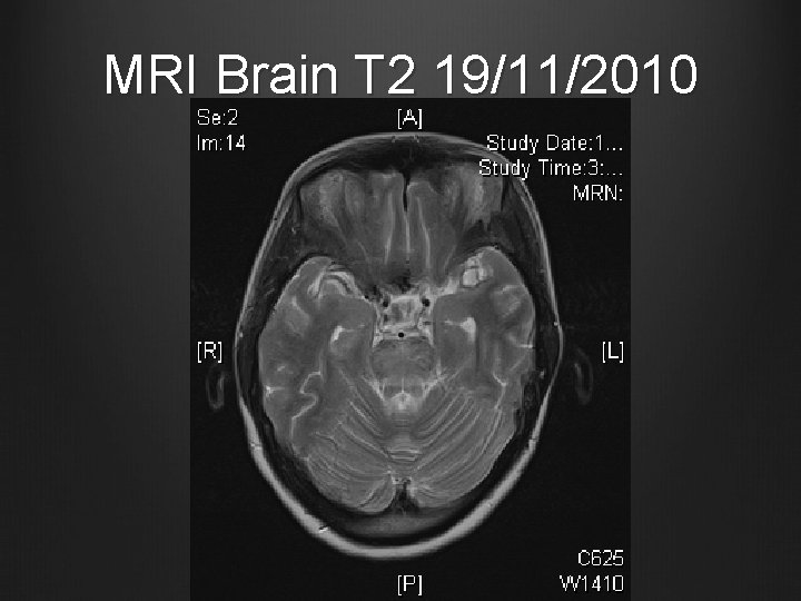 MRI Brain T 2 19/11/2010 