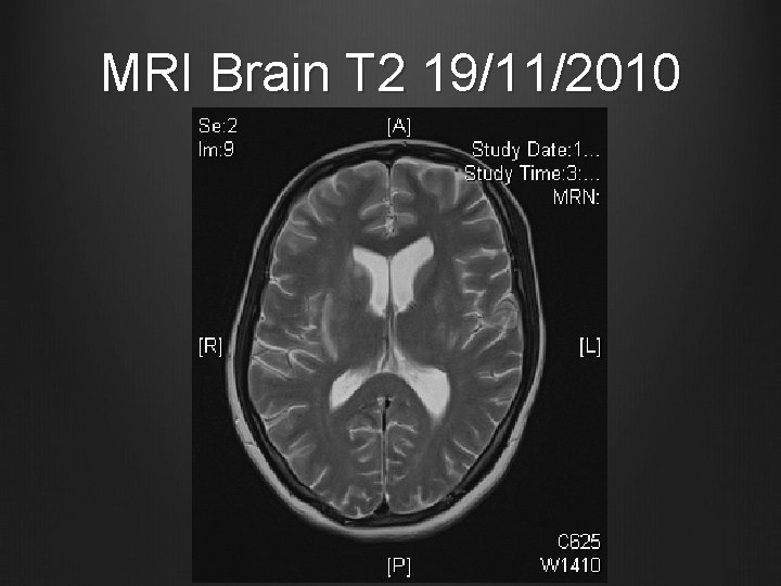 MRI Brain T 2 19/11/2010 