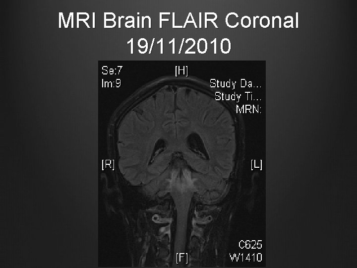 MRI Brain FLAIR Coronal 19/11/2010 