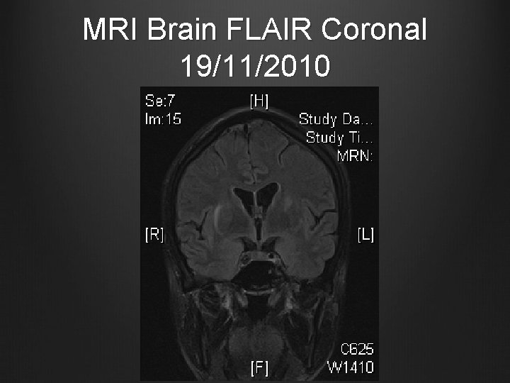 MRI Brain FLAIR Coronal 19/11/2010 