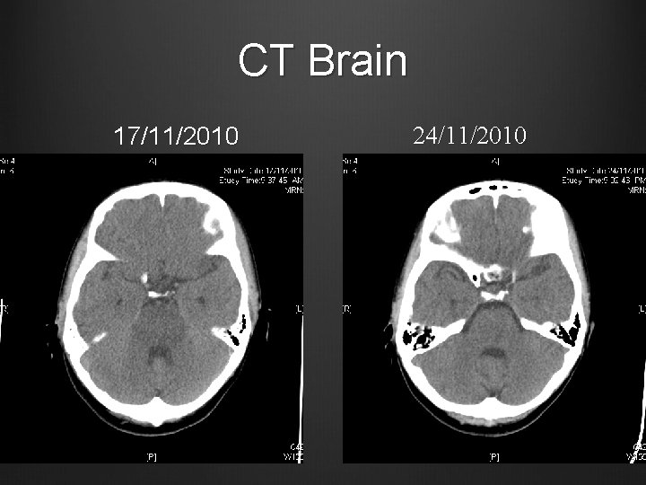 CT Brain 17/11/2010 24/11/2010 