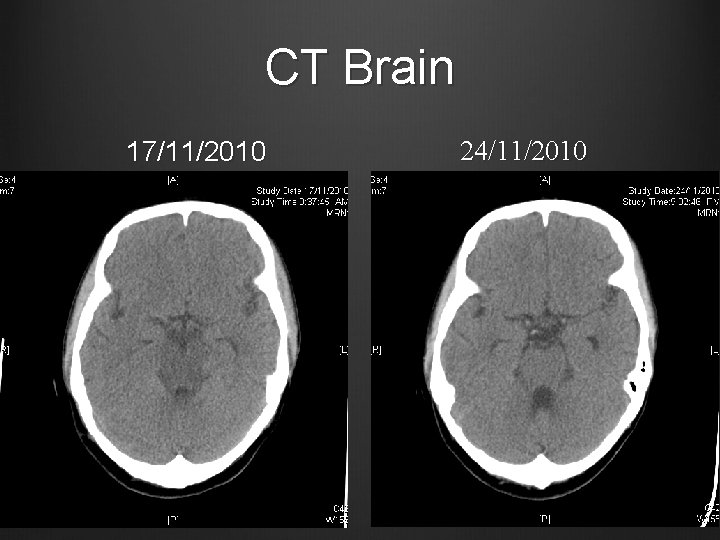 CT Brain 17/11/2010 24/11/2010 