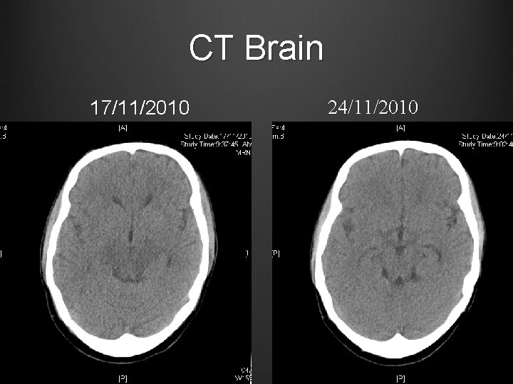 CT Brain 17/11/2010 24/11/2010 