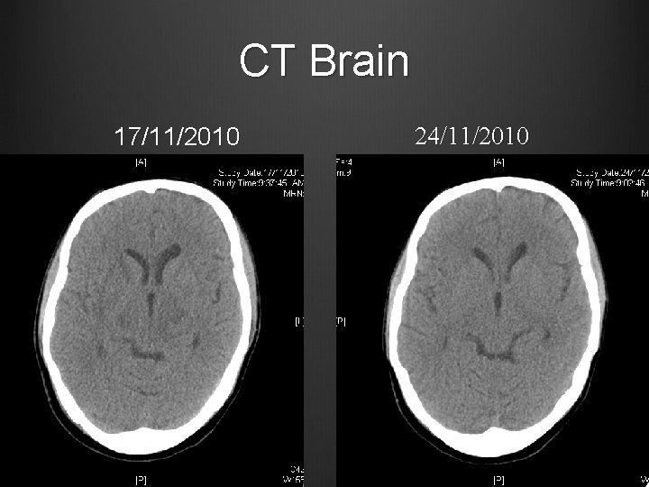 CT Brain 17/11/2010 24/11/2010 