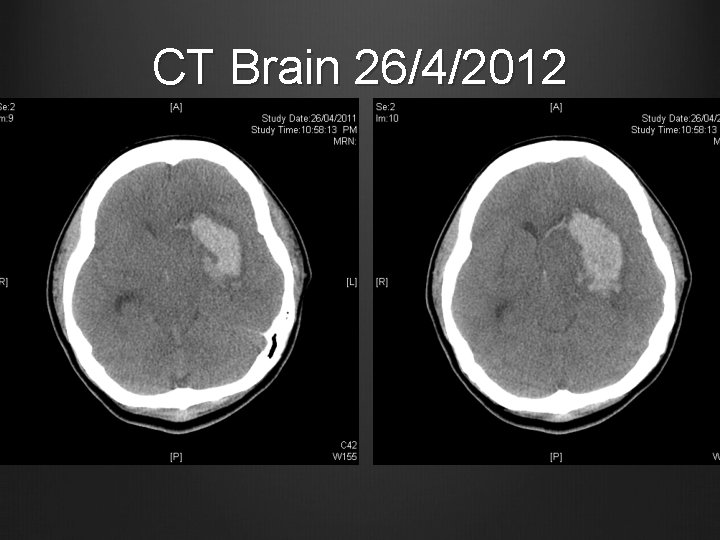 CT Brain 26/4/2012 