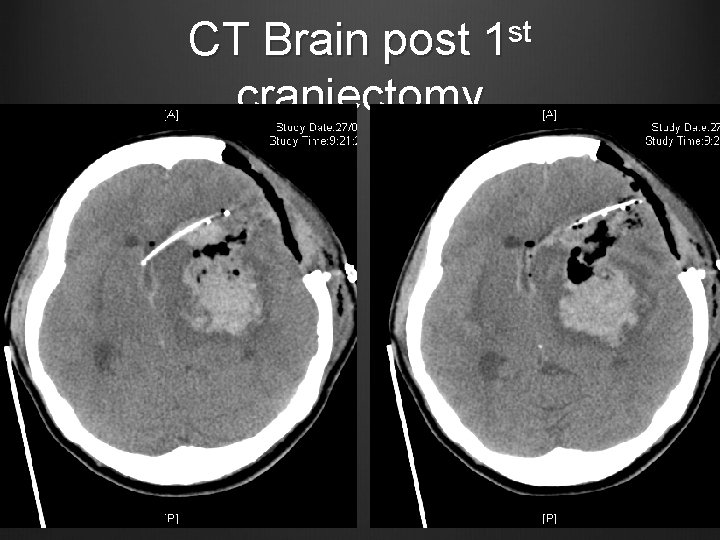 CT Brain post 1 st craniectomy 
