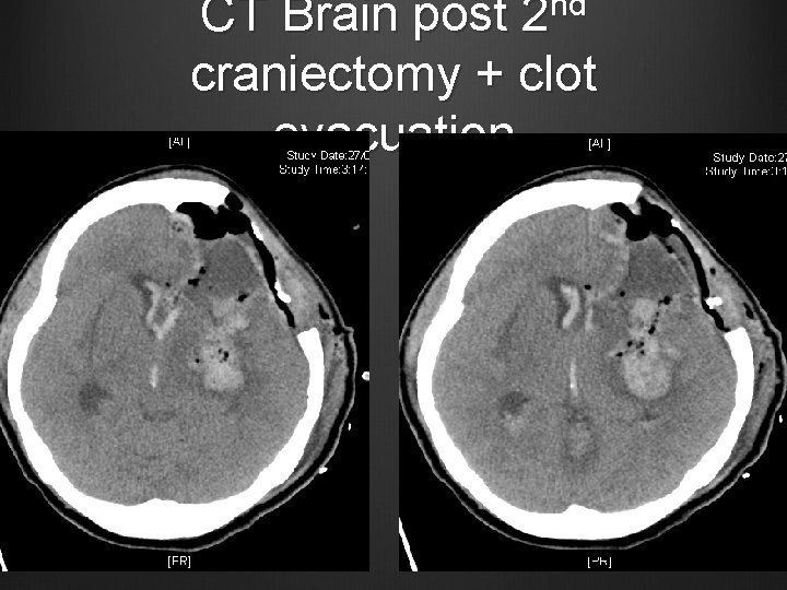 CT Brain post 2 nd craniectomy + clot evacuation 