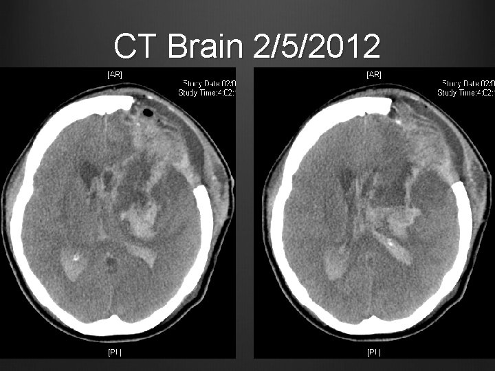 CT Brain 2/5/2012 