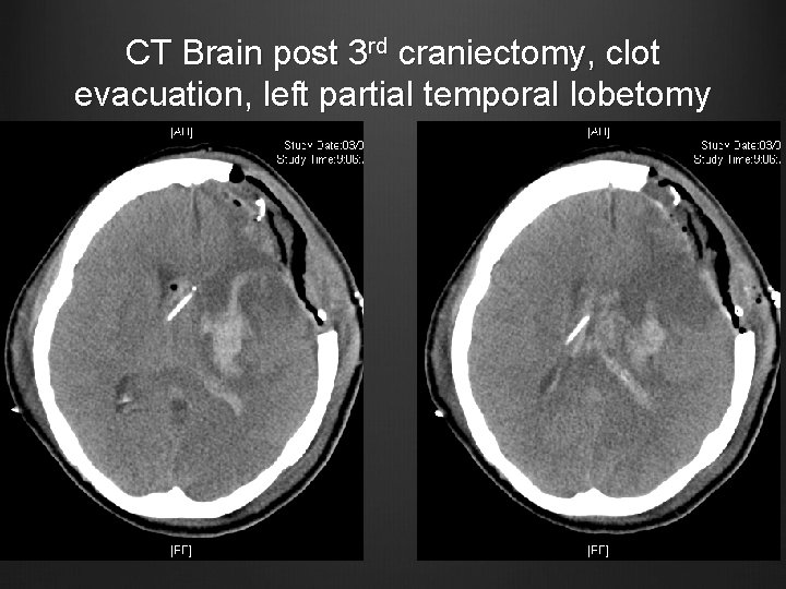 CT Brain post 3 rd craniectomy, clot evacuation, left partial temporal lobetomy 