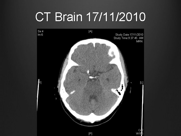 CT Brain 17/11/2010 