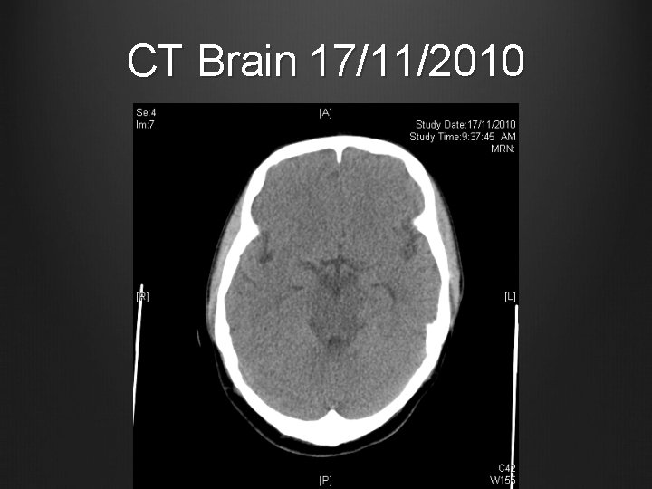 CT Brain 17/11/2010 