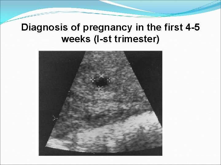 Diagnosis of pregnancy in the first 4 -5 weeks (I-st trimester) 