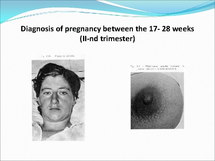 Diagnosis of pregnancy between the 17 - 28 weeks (II-nd trimester) 