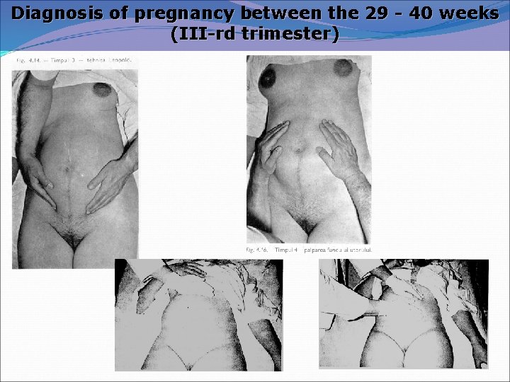 Diagnosis of pregnancy between the 29 - 40 weeks (III-rd trimester) 