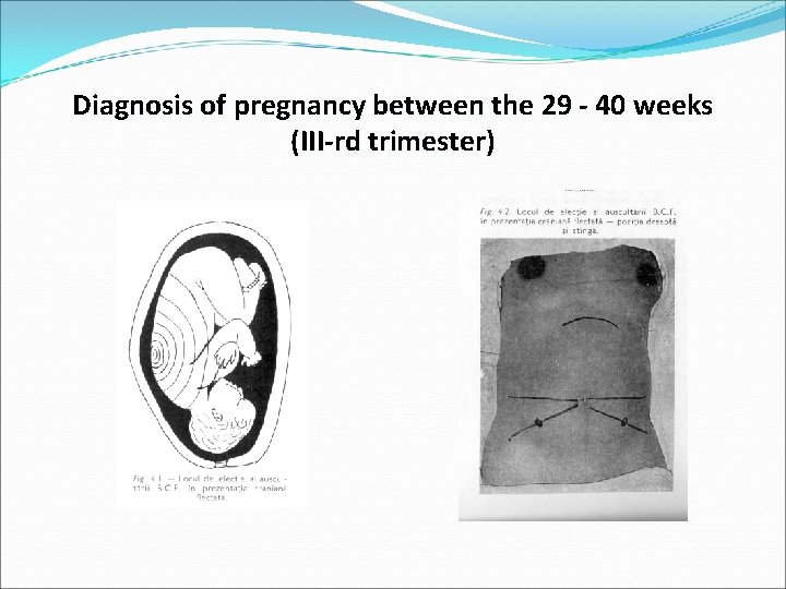 Diagnosis of pregnancy between the 29 - 40 weeks (III-rd trimester) 