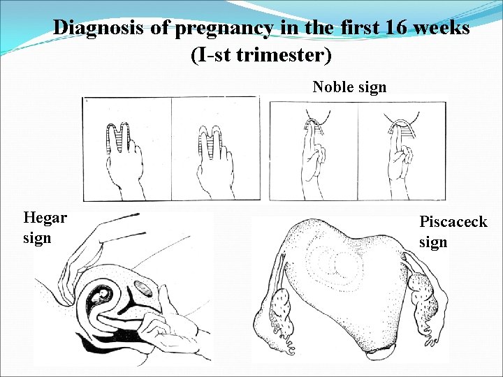 Diagnosis of pregnancy in the first 16 weeks (I-st trimester) Noble sign Hegar sign