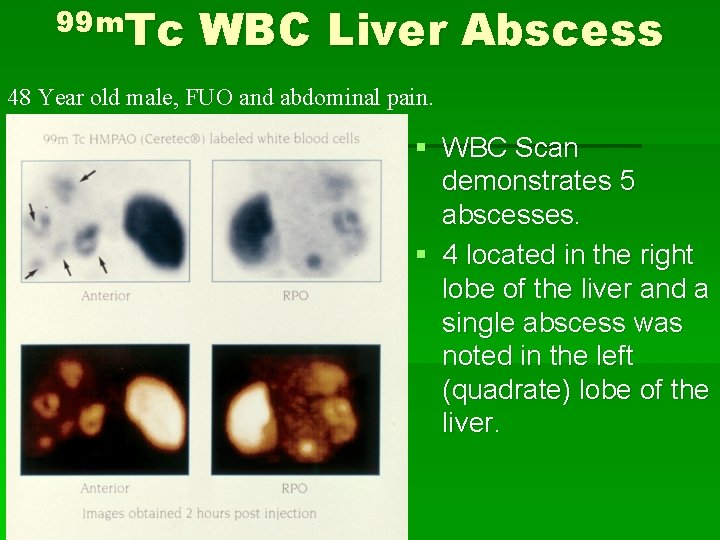 99 m. Tc WBC Liver Abscess 48 Year old male, FUO and abdominal pain.
