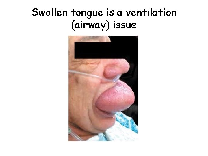 Swollen tongue is a ventilation (airway) issue 