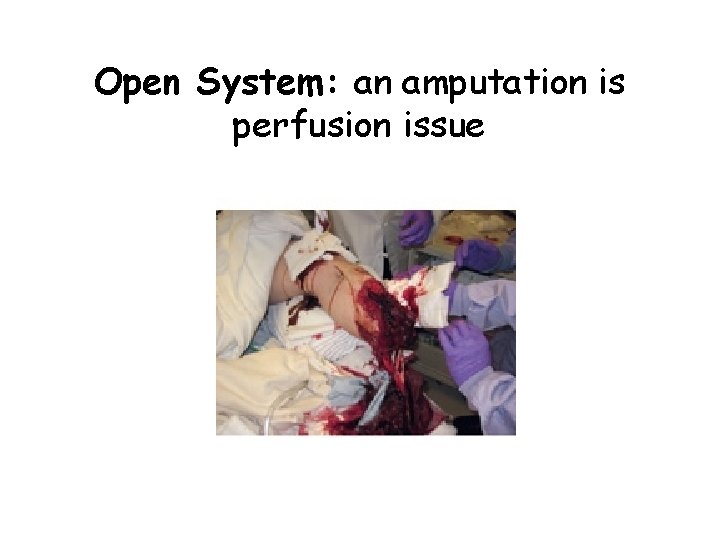 Open System: an amputation is perfusion issue 
