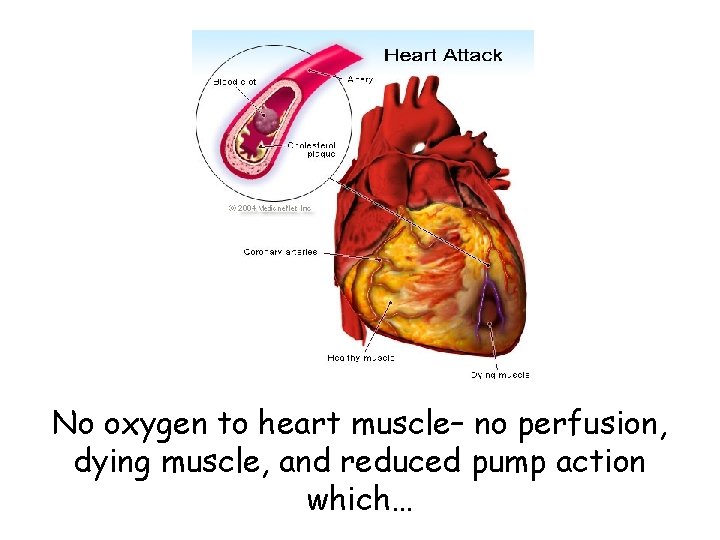 No oxygen to heart muscle– no perfusion, dying muscle, and reduced pump action which…