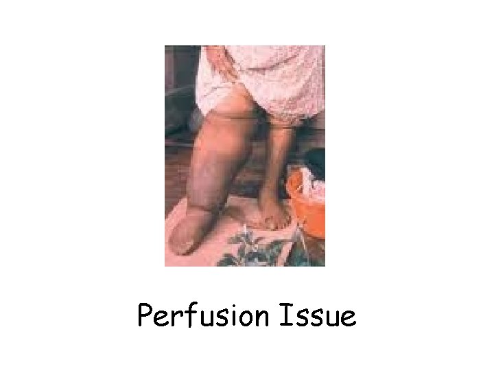 Perfusion Issue 