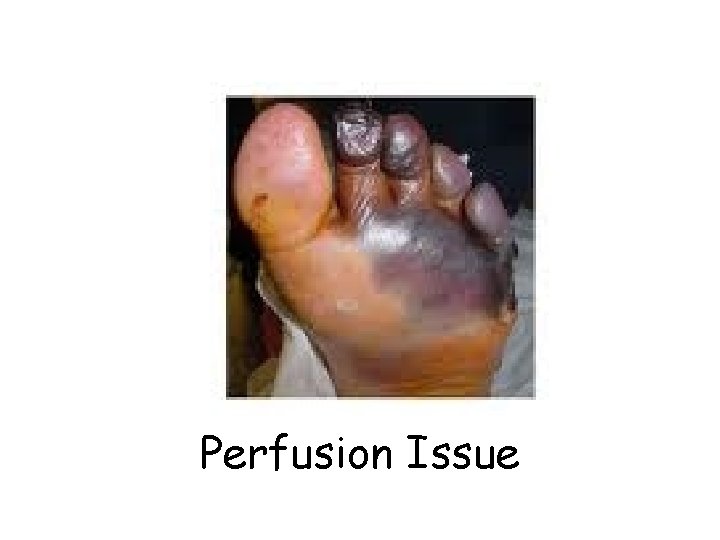 Perfusion Issue 