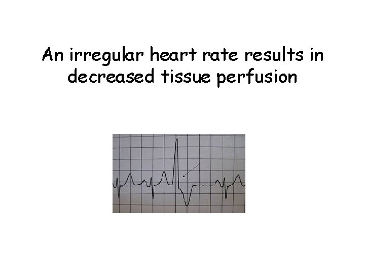 An irregular heart rate results in decreased tissue perfusion 