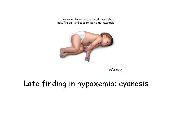 Late finding in hypoxemia: cyanosis 