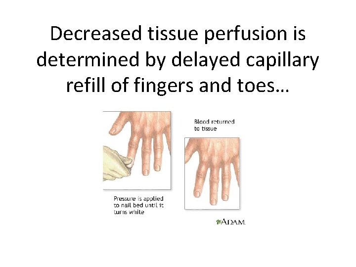 Decreased tissue perfusion is determined by delayed capillary refill of fingers and toes… 