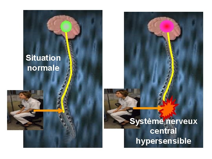 Situation normale Système nerveux central hypersensible 