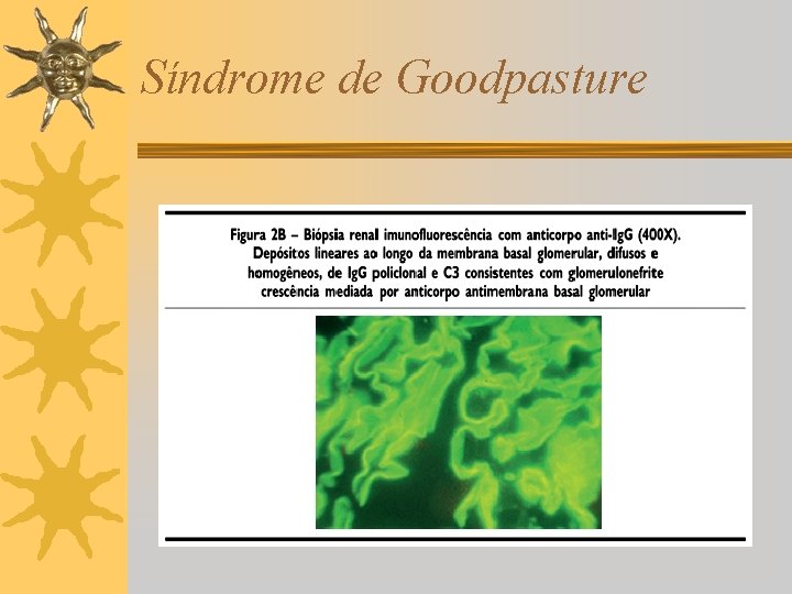 Síndrome de Goodpasture 