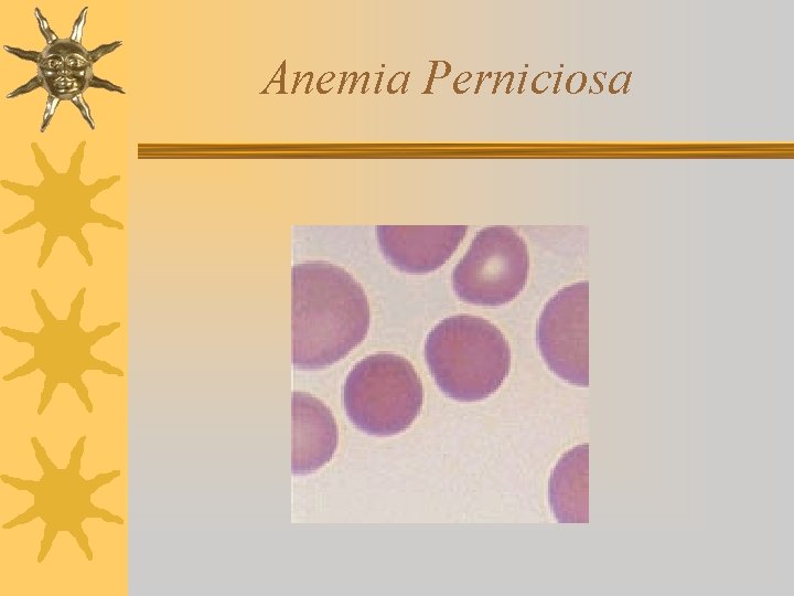 Anemia Perniciosa 