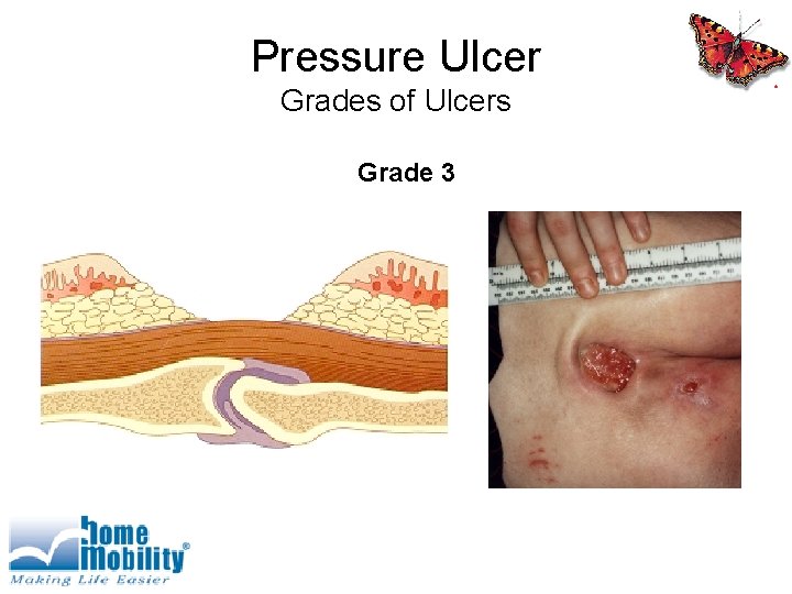 Pressure Ulcer Grades of Ulcers Grade 3 