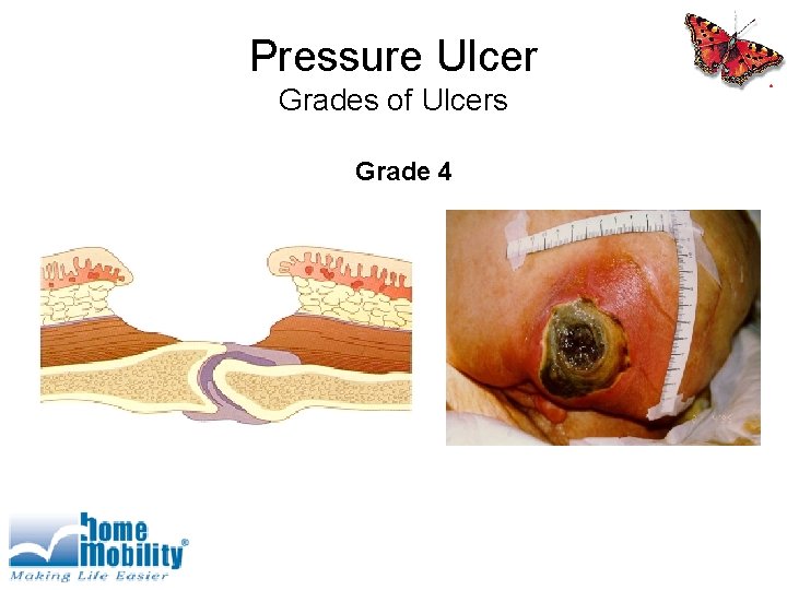 Pressure Ulcer Grades of Ulcers Grade 4 